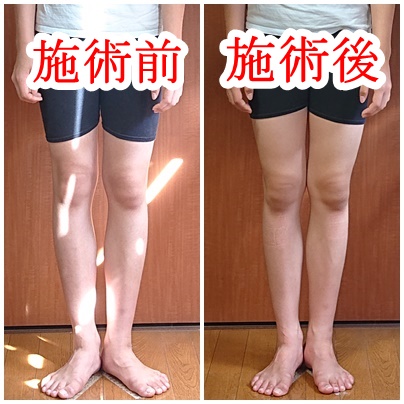 O脚の立ち方