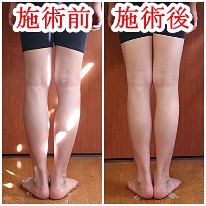 Ｏ脚を後ろから