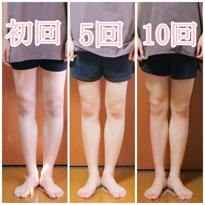 O脚矯正　経過　17歳　クラシックバレエ